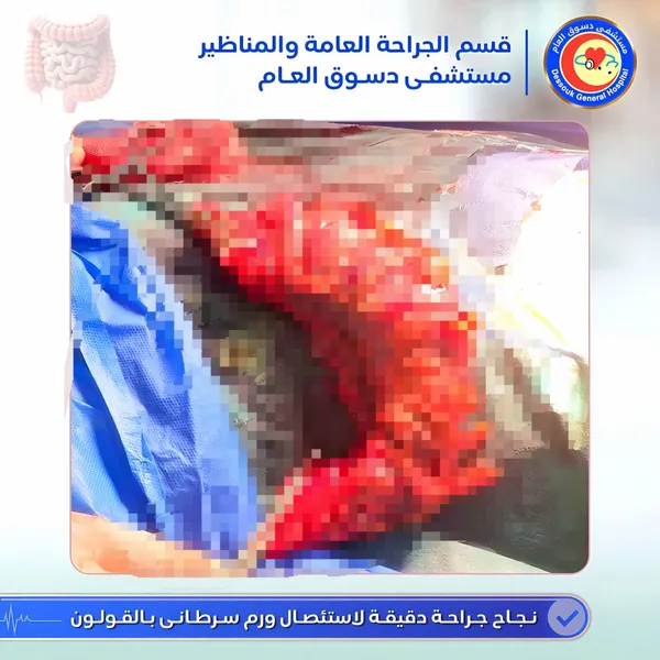 أطباء مستشفى دسوق العام ينجحون في استئصال ورم سرطانى بالقولون لمريض