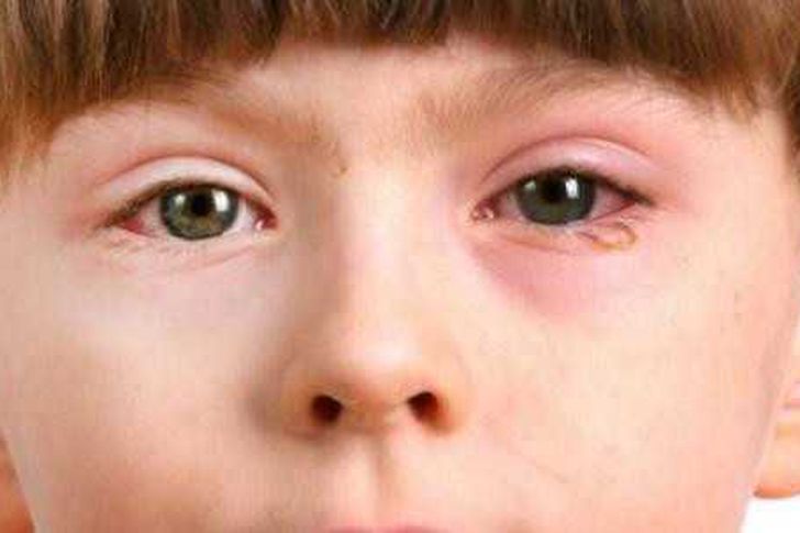 أعراض أمراض شبكية العين عند الأطفال وأنواعها | أهل مصر