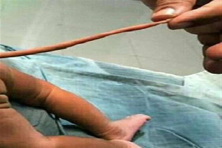 ولادة طفل بذيل وكرة بنهايته في حالة طبية نادرة بالبرازيل (صور) | أهل مصر