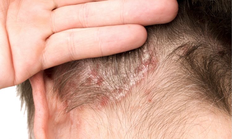 حبوب فروة الرأس.. التوتر من أسبابها وتقصف الشعر من الأعراض | أهل مصر